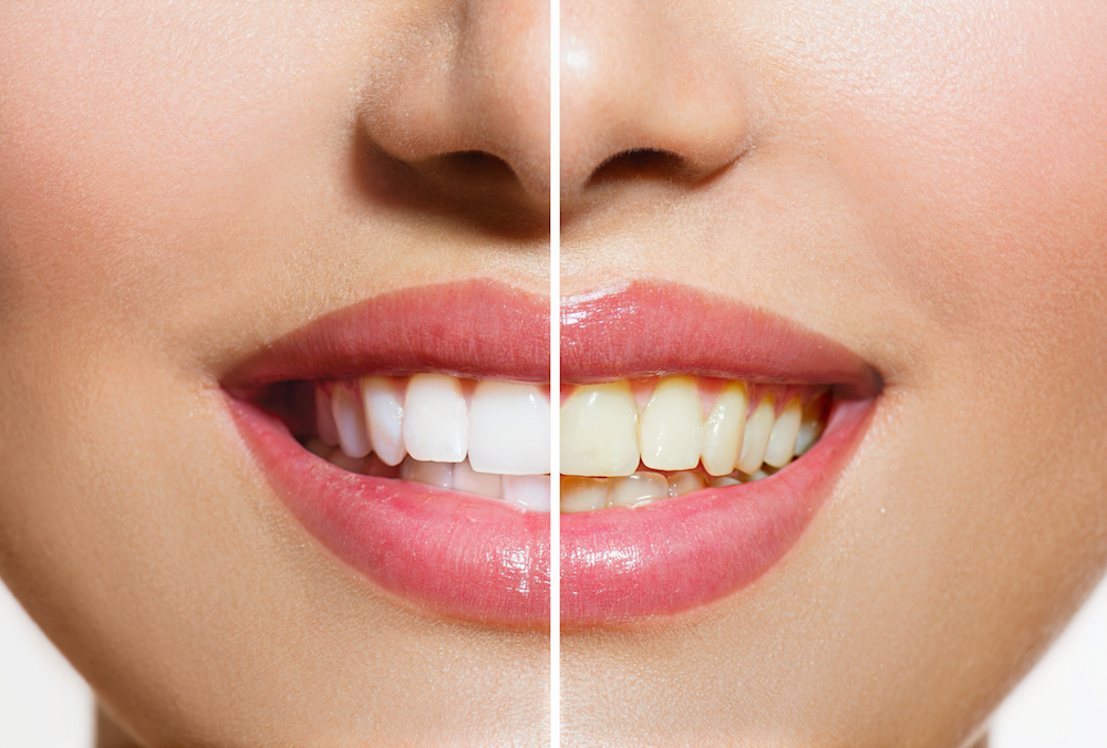 Stained Teeth | Dentist in Norfolk NE